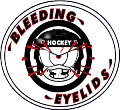 Bleeding Eyelids Hockey Webpage Bleeding Eyelids Hockey Webpage